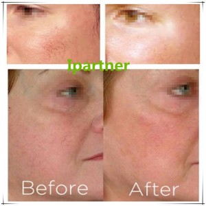 Ipartner LS980 Diode Laser làm giảm hệ thống đỏ