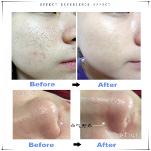 Ipartner Hydrogen oxy bong bóng nhỏ hydrofacial 6 in 1 đa chức năng làm sạch da