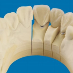 Kim loại-răng sứ